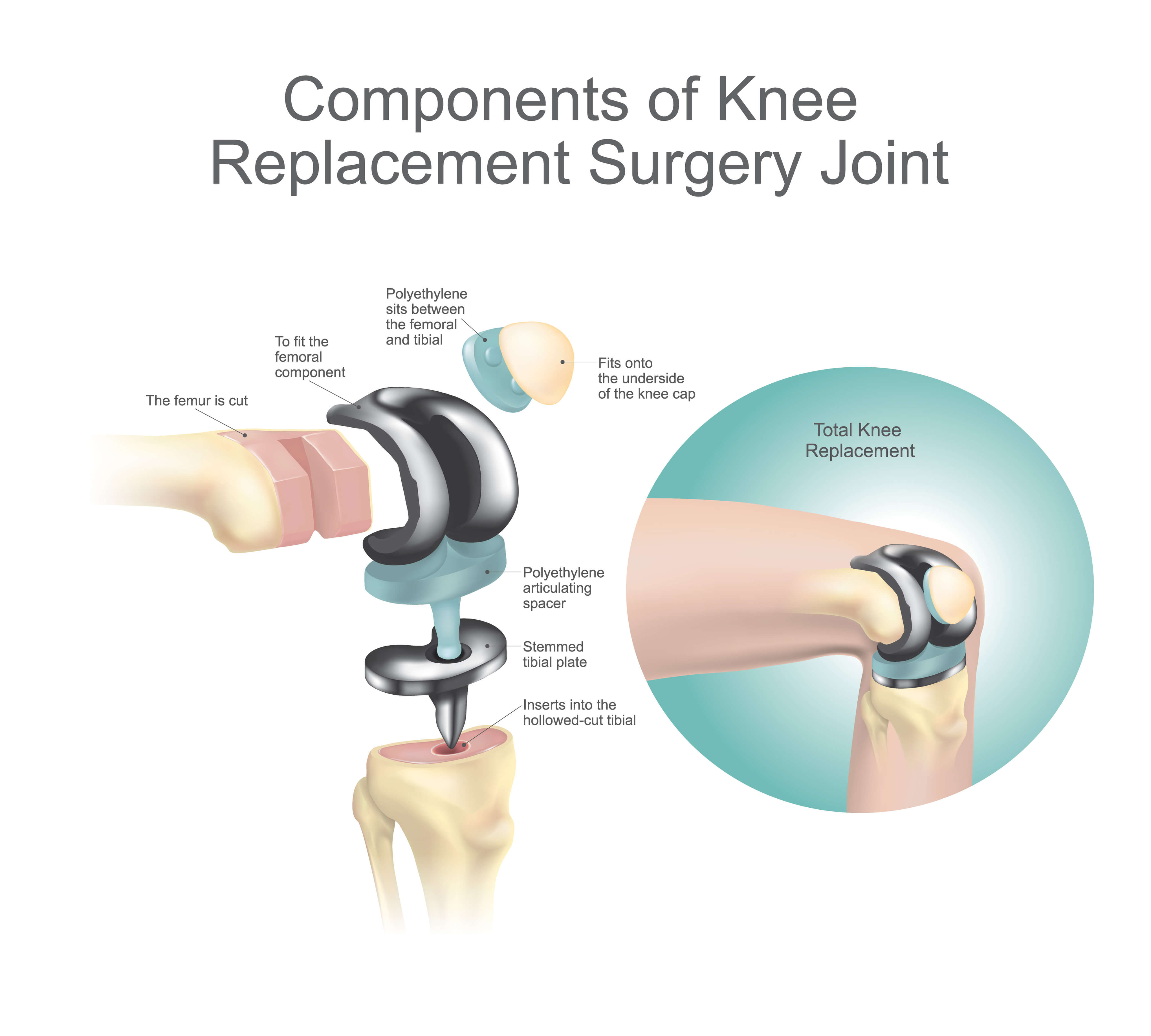 Explanation of Knee Replacement